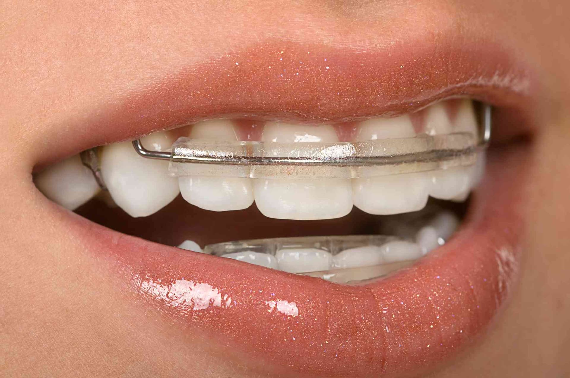 How Ceramic Braces Work to Straighten Your Smile
